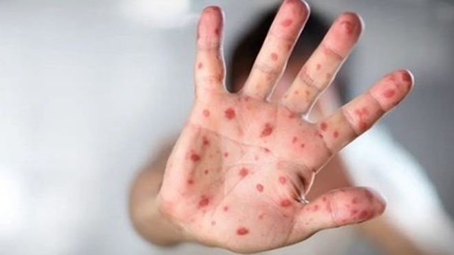 Of 20 monkeypox cases, 18 diagnosed with B20