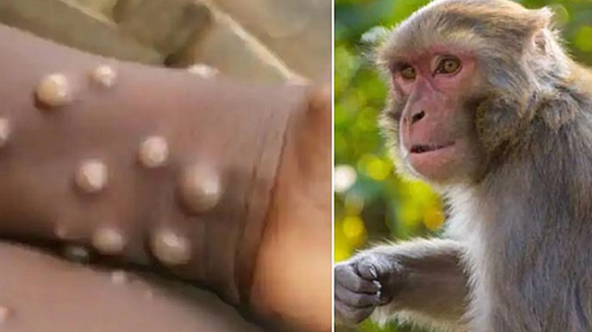 Vietnam likely to record more new monkeypox cases: Ministry
