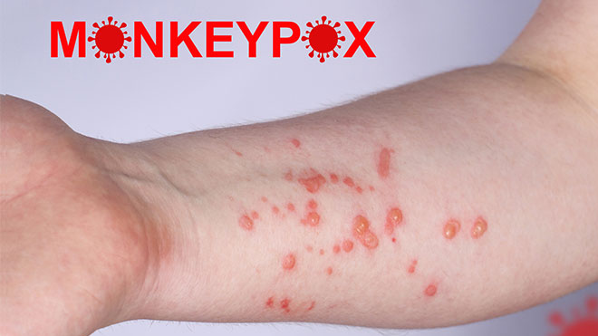 MoH discovers the 12th case of monkeypox in a man in Phnom Penh