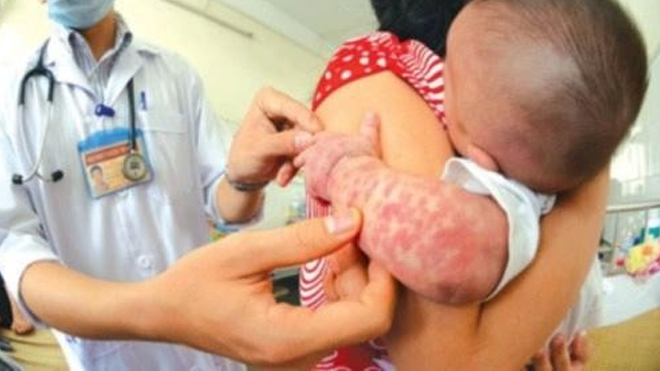 Ministry directs to take measures against measles