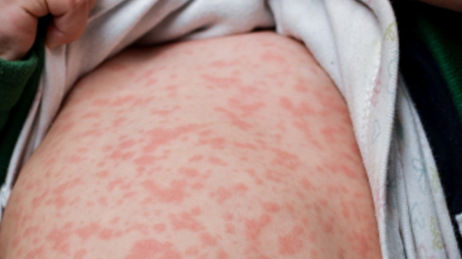 Medical workers fear widespread measles in HCMC after detecting new cases